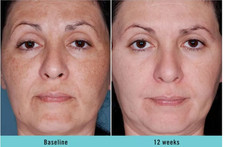 Skin Bleaching Cream for Dark