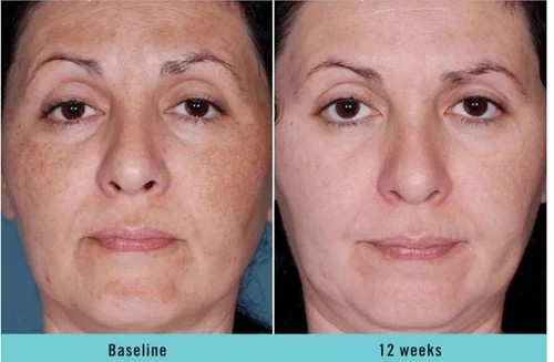 Skin bleaching cream for dark - skin,